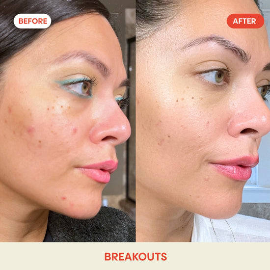 hypochlorous acid facial mist before after face