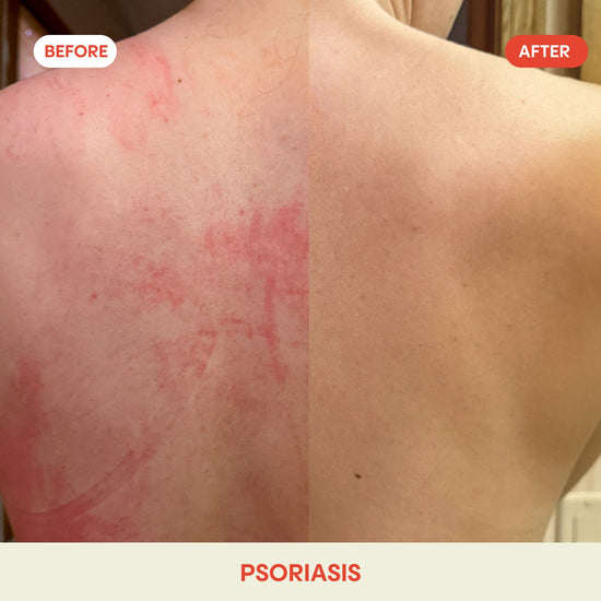 hypochlorous acid facial mist before after